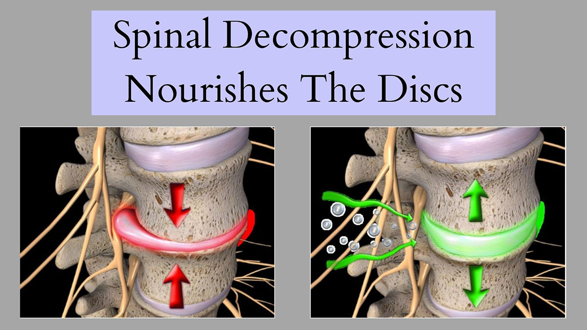 How spinal decompression relieves pressure on discs
